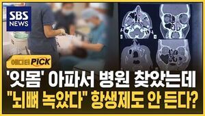 '잇몸' 아파서 병원 찾았는데.."뇌뼈 녹았다" 항생제도 무용지물?