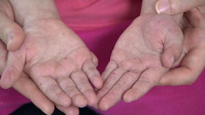 Hand, Foot, and Mouth Disease Cases Triple in One Month; No Vaccine or Treatment Available