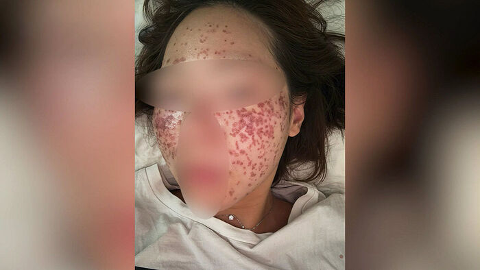 주근깨 없애려다 '2도 화상'…"비뇨기과 전문의였다"