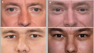 Do Eyes Appear Smaller in Space? Lower Eyelid Rises by Average of 1 mm