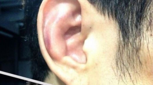 윤형빈 귀 모양 "훈장 달았다" 피멍 들고 퉁퉁 부어오른 모습 안쓰러워